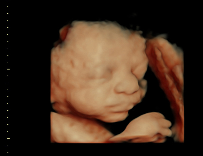 3D ultrasound image at 31 weeks